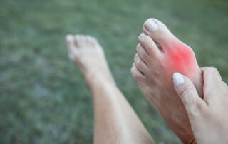 Bunions - What Causes Them and What Can I do?