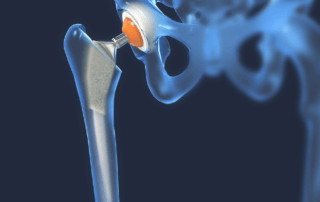 Hip and Joint Replacement Surgery