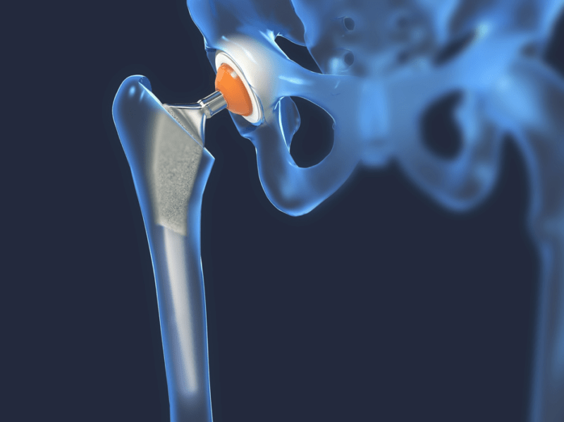 Hip and Knee Joint Replacement Surgery: How Is It Done? | Santa Rosa ...
