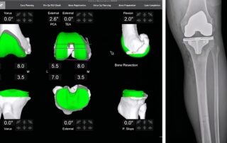 Mako Total Knee Snyder