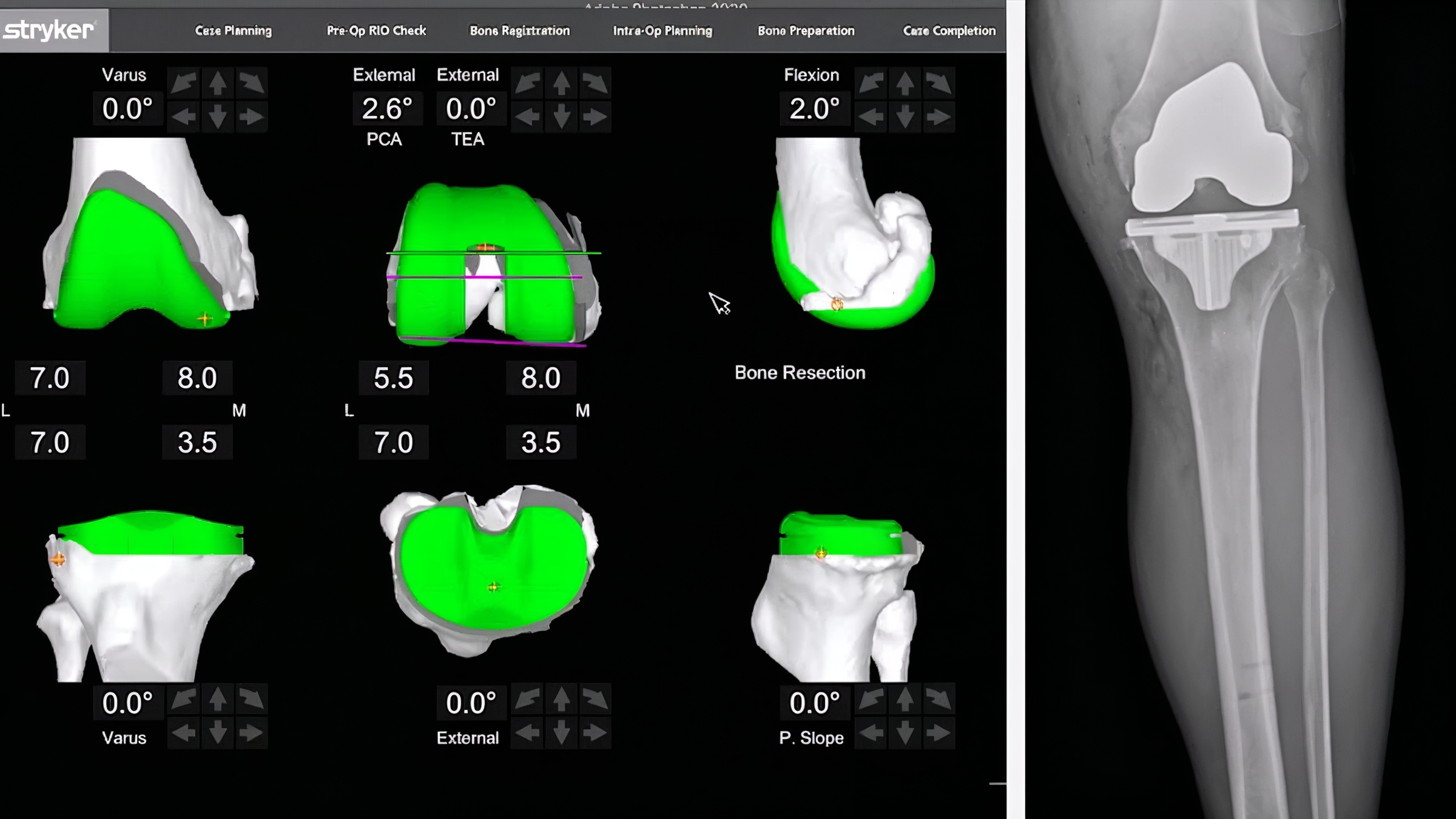 Mako Total Knee Snyder